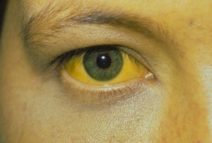 Looking in the future: This could be you. By the time Hep B individual is jaundiced, the liver is already seriously damaged. Source: WebMD.com
